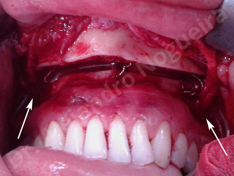 Small chin,Weak chin,Horizontal chin osteotomy,One dimensional genioplasty,Osseous chin advancement - photo 9