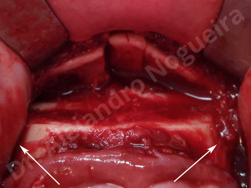 Large chin,Prominent chin,Small chin,Transgender chin,Weak chin,Horizontal osseous chin resection,Oblique chin osteotomy,Osseous chin setback,Three dimensional genioplasty - photo 10