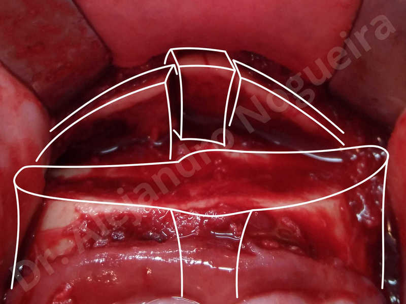 Large chin,Prominent chin,Small chin,Transgender chin,Weak chin,Horizontal osseous chin resection,Oblique chin osteotomy,Osseous chin setback,Three dimensional genioplasty - photo 11