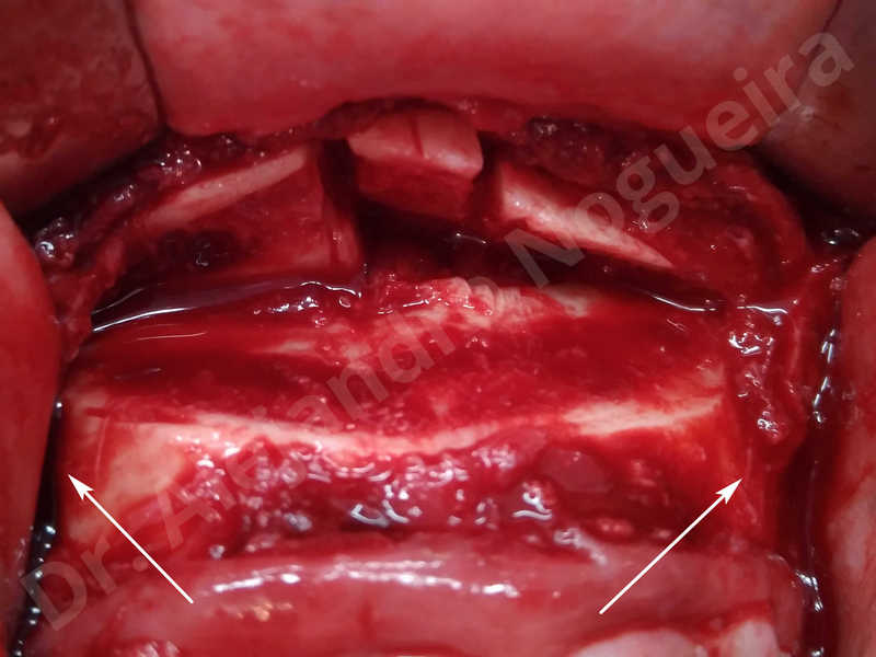 Large chin,Prominent chin,Small chin,Transgender chin,Weak chin,Horizontal osseous chin resection,Oblique chin osteotomy,Osseous chin setback,Three dimensional genioplasty - photo 12