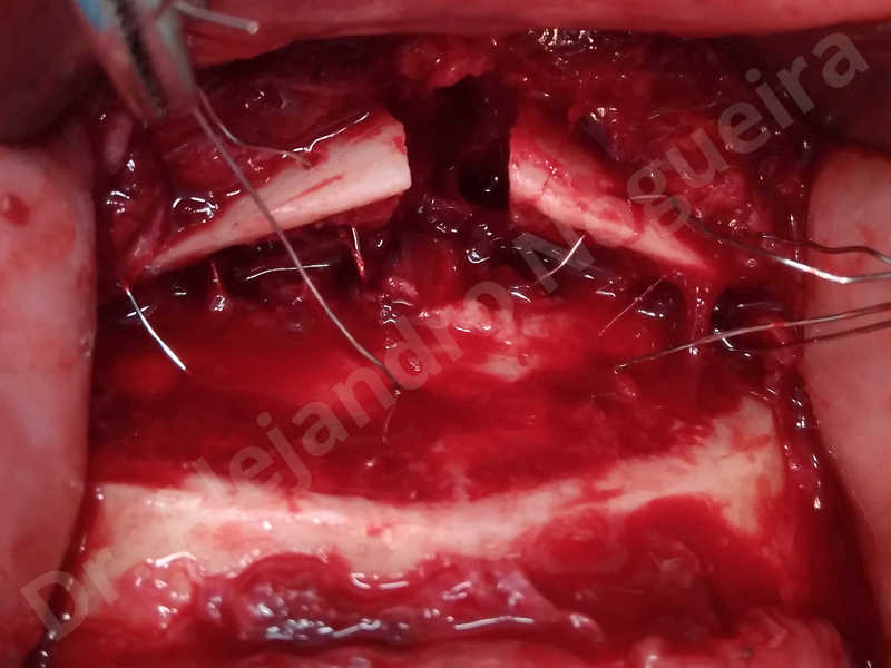 Large chin,Prominent chin,Small chin,Transgender chin,Weak chin,Horizontal osseous chin resection,Oblique chin osteotomy,Osseous chin setback,Three dimensional genioplasty - photo 13