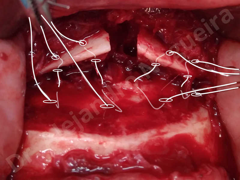 Large chin,Prominent chin,Small chin,Transgender chin,Weak chin,Horizontal osseous chin resection,Oblique chin osteotomy,Osseous chin setback,Three dimensional genioplasty - photo 14