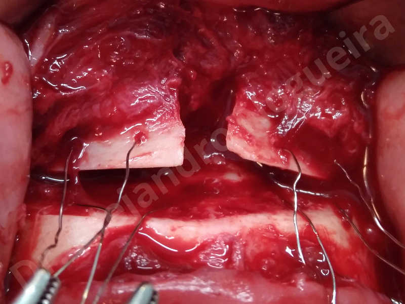Large chin,Prominent chin,Small chin,Transgender chin,Weak chin,Horizontal osseous chin resection,Oblique chin osteotomy,Osseous chin setback,Three dimensional genioplasty - photo 16