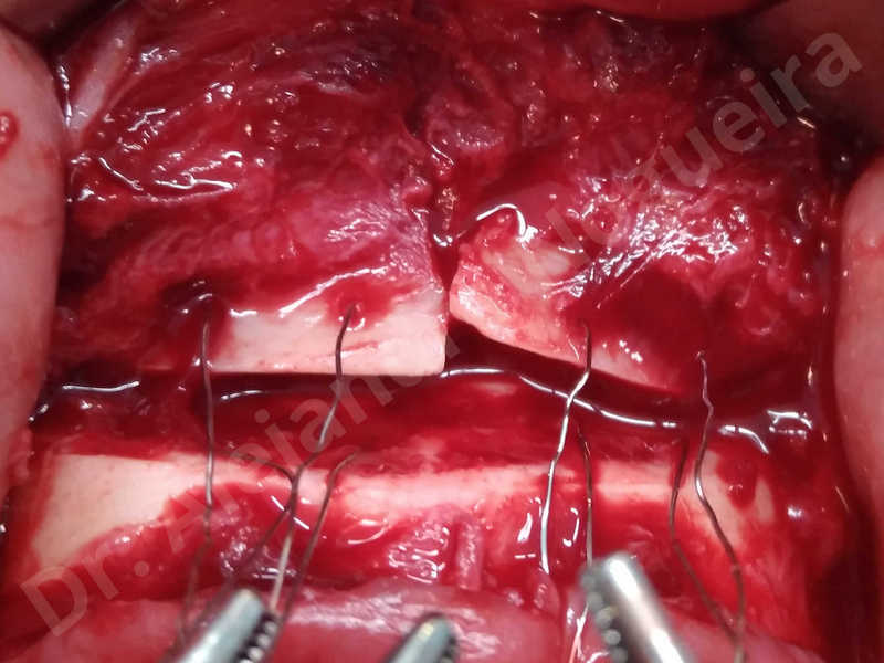 Large chin,Prominent chin,Small chin,Transgender chin,Weak chin,Horizontal osseous chin resection,Oblique chin osteotomy,Osseous chin setback,Three dimensional genioplasty - photo 17
