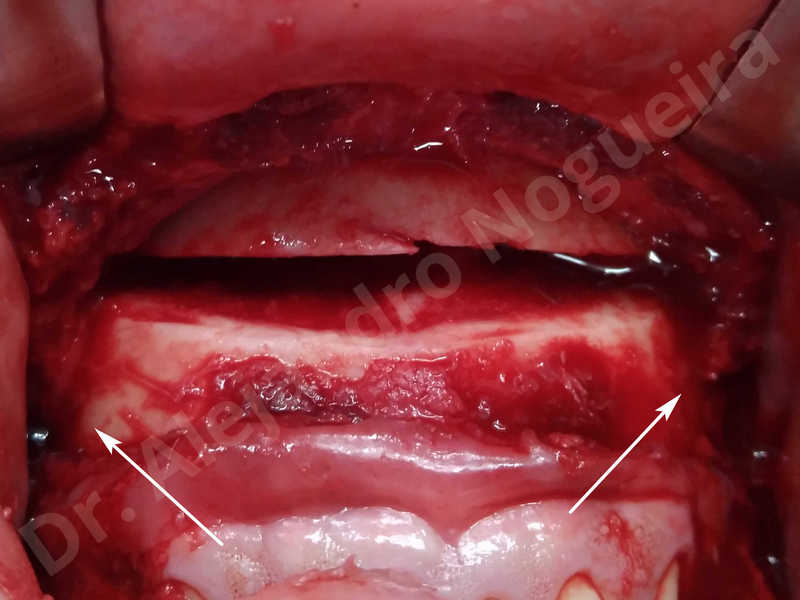 Large chin,Prominent chin,Small chin,Transgender chin,Weak chin,Horizontal osseous chin resection,Oblique chin osteotomy,Osseous chin setback,Three dimensional genioplasty - photo 5