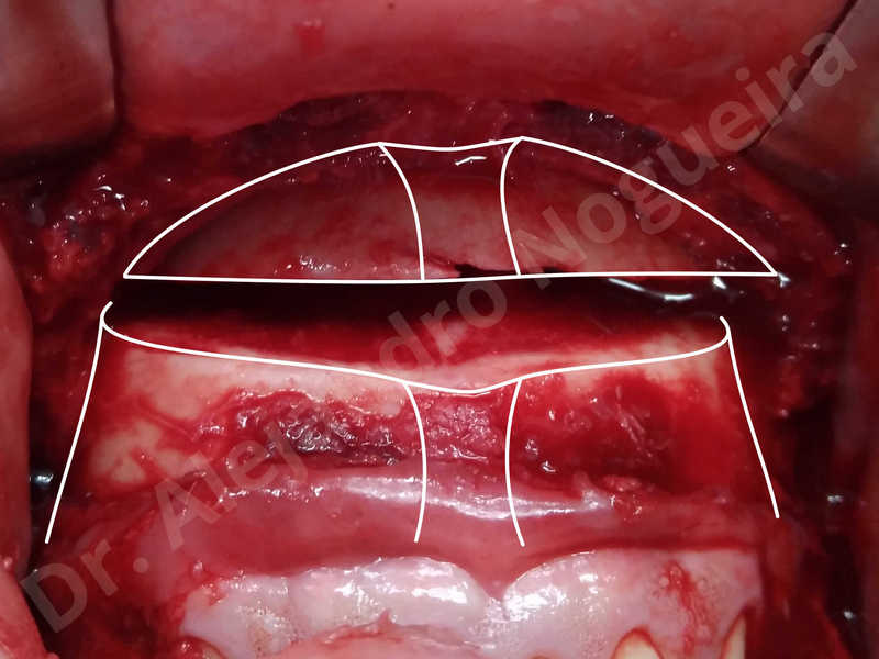 Large chin,Prominent chin,Small chin,Transgender chin,Weak chin,Horizontal osseous chin resection,Oblique chin osteotomy,Osseous chin setback,Three dimensional genioplasty - photo 6