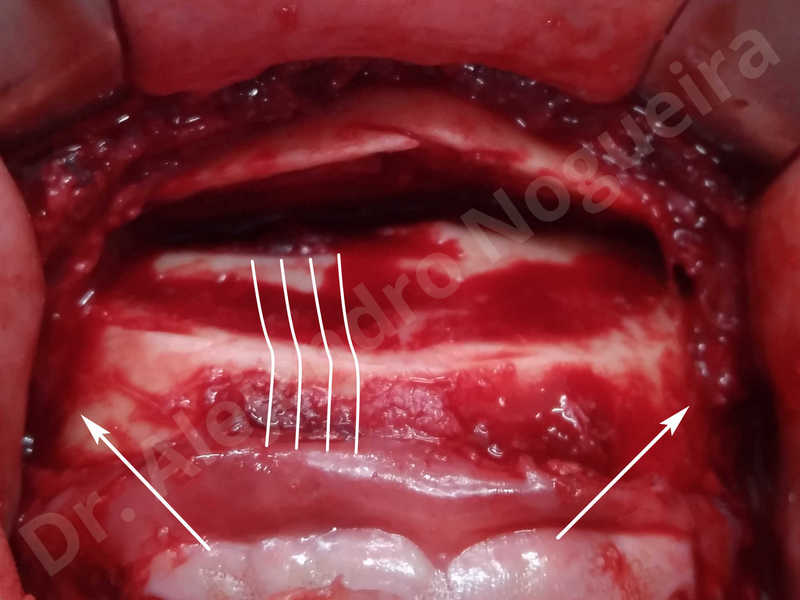 Large chin,Prominent chin,Small chin,Transgender chin,Weak chin,Horizontal osseous chin resection,Oblique chin osteotomy,Osseous chin setback,Three dimensional genioplasty - photo 9