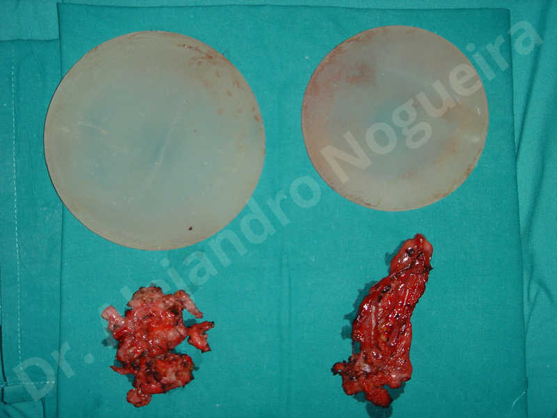 Breast implants capsular contracture,Asymmetric breasts,Empty breasts,Too narrow breast implants,Capsulectomy - photo 2