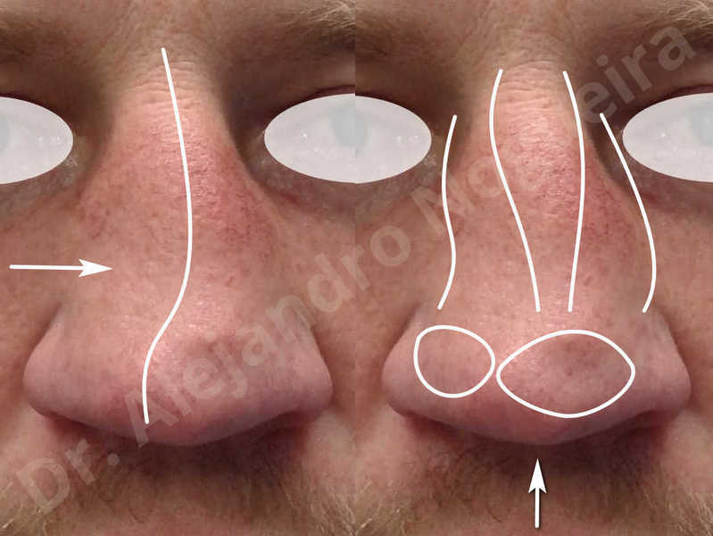 Alar flaring,Alar rim retraction,Asymmetric nose,Asymmetric tip,Bifid columella,Bifid tip,Broad dorsum,Broad nose,Concave lateral cruras,Congenital nose,Crooked nose,Crooked septum,Crooked tip,Dorsum hump,Dorsum ridges,Droopy tip,Failed osteotomies,Flat dorsum,Irregular dorsum,Large alar cartilages,Large nose,Large nostrils,Large sills,Nasal fibrosis,Nasal valve collapse,Overprojected tip,Pinched middle vault,Pinched nose,Plunging tip deformity,Poorly defined tip,Poorly supported tip,Posttraumatic nose,Rhomboid dorsum,Saddle nose deformity,Short septum,Short upper lateral cartilages,Sunken columella,Sunken supratip,Thick skin nose,Tip bossae,Underprojected tip,Alar base resection alarplasty,Columella strut graft,Dorsum hump resection,Dorsum regularization,Extended columella strut graft,Intercrural columella plasty sutures,Interdomal tip plasty sutures,Lateral cruras cephalic resection,Lateral cruras plasty sutures,Lateral cruras repositioning,Lateral cruras shortening resection,Medial cruras shortening resection,Nasal bones osteotomies,Nostril sill resection,Onlay dorsum graft,Onlay supratip graft,Open approach incision,Rib cartilage graft harvesting,Septocolumella graft,Septum caudal extension graft,Septum replacement graft,Spreader graft,Temporalis fascia graft harvesting,Tip defatting,Transdomal tip plasty sutures,Triangular cartilages caudal extension graft - photo 2