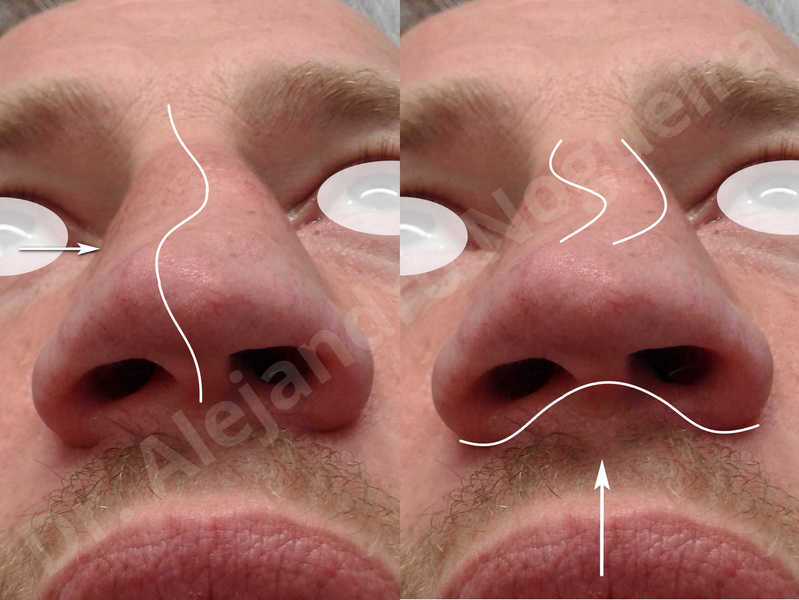 Alar flaring,Alar rim retraction,Asymmetric nose,Asymmetric tip,Bifid columella,Bifid tip,Broad dorsum,Broad nose,Concave lateral cruras,Congenital nose,Crooked nose,Crooked septum,Crooked tip,Dorsum hump,Dorsum ridges,Droopy tip,Failed osteotomies,Flat dorsum,Irregular dorsum,Large alar cartilages,Large nose,Large nostrils,Large sills,Nasal fibrosis,Nasal valve collapse,Overprojected tip,Pinched middle vault,Pinched nose,Plunging tip deformity,Poorly defined tip,Poorly supported tip,Posttraumatic nose,Rhomboid dorsum,Saddle nose deformity,Short septum,Short upper lateral cartilages,Sunken columella,Sunken supratip,Thick skin nose,Tip bossae,Underprojected tip,Alar base resection alarplasty,Columella strut graft,Dorsum hump resection,Dorsum regularization,Extended columella strut graft,Intercrural columella plasty sutures,Interdomal tip plasty sutures,Lateral cruras cephalic resection,Lateral cruras plasty sutures,Lateral cruras repositioning,Lateral cruras shortening resection,Medial cruras shortening resection,Nasal bones osteotomies,Nostril sill resection,Onlay dorsum graft,Onlay supratip graft,Open approach incision,Rib cartilage graft harvesting,Septocolumella graft,Septum caudal extension graft,Septum replacement graft,Spreader graft,Temporalis fascia graft harvesting,Tip defatting,Transdomal tip plasty sutures,Triangular cartilages caudal extension graft - photo 3