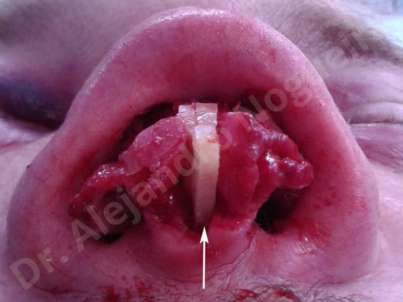 Alar flaring,Alar rim retraction,Asymmetric nose,Asymmetric tip,Bifid columella,Bifid tip,Broad dorsum,Broad nose,Concave lateral cruras,Congenital nose,Crooked nose,Crooked septum,Crooked tip,Dorsum hump,Dorsum ridges,Droopy tip,Failed osteotomies,Flat dorsum,Irregular dorsum,Large alar cartilages,Large nose,Large nostrils,Large sills,Nasal fibrosis,Nasal valve collapse,Overprojected tip,Pinched middle vault,Pinched nose,Plunging tip deformity,Poorly defined tip,Poorly supported tip,Posttraumatic nose,Rhomboid dorsum,Saddle nose deformity,Short septum,Short upper lateral cartilages,Sunken columella,Sunken supratip,Thick skin nose,Tip bossae,Underprojected tip,Alar base resection alarplasty,Columella strut graft,Dorsum hump resection,Dorsum regularization,Extended columella strut graft,Intercrural columella plasty sutures,Interdomal tip plasty sutures,Lateral cruras cephalic resection,Lateral cruras plasty sutures,Lateral cruras repositioning,Lateral cruras shortening resection,Medial cruras shortening resection,Nasal bones osteotomies,Nostril sill resection,Onlay dorsum graft,Onlay supratip graft,Open approach incision,Rib cartilage graft harvesting,Septocolumella graft,Septum caudal extension graft,Septum replacement graft,Spreader graft,Temporalis fascia graft harvesting,Tip defatting,Transdomal tip plasty sutures,Triangular cartilages caudal extension graft - photo 48