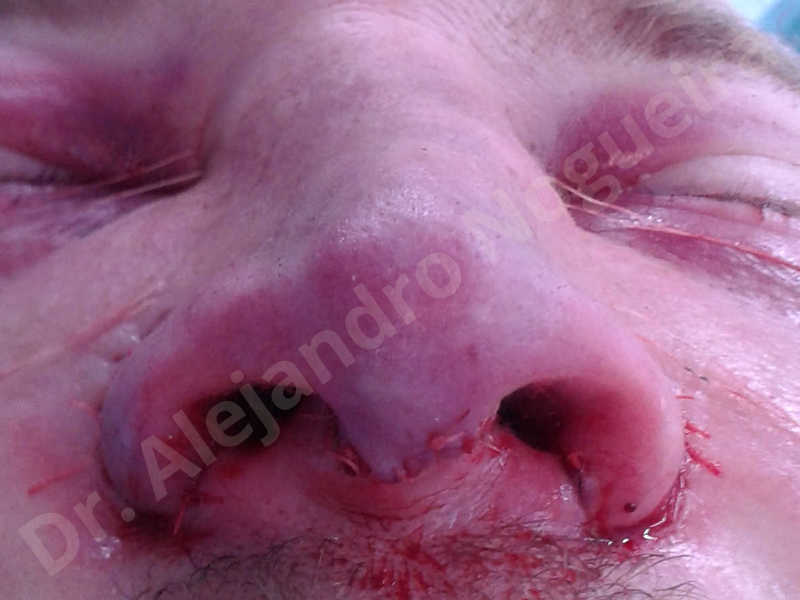 Alar flaring,Alar rim retraction,Asymmetric nose,Asymmetric tip,Bifid columella,Bifid tip,Broad dorsum,Broad nose,Concave lateral cruras,Congenital nose,Crooked nose,Crooked septum,Crooked tip,Dorsum hump,Dorsum ridges,Droopy tip,Failed osteotomies,Flat dorsum,Irregular dorsum,Large alar cartilages,Large nose,Large nostrils,Large sills,Nasal fibrosis,Nasal valve collapse,Overprojected tip,Pinched middle vault,Pinched nose,Plunging tip deformity,Poorly defined tip,Poorly supported tip,Posttraumatic nose,Rhomboid dorsum,Saddle nose deformity,Short septum,Short upper lateral cartilages,Sunken columella,Sunken supratip,Thick skin nose,Tip bossae,Underprojected tip,Alar base resection alarplasty,Columella strut graft,Dorsum hump resection,Dorsum regularization,Extended columella strut graft,Intercrural columella plasty sutures,Interdomal tip plasty sutures,Lateral cruras cephalic resection,Lateral cruras plasty sutures,Lateral cruras repositioning,Lateral cruras shortening resection,Medial cruras shortening resection,Nasal bones osteotomies,Nostril sill resection,Onlay dorsum graft,Onlay supratip graft,Open approach incision,Rib cartilage graft harvesting,Septocolumella graft,Septum caudal extension graft,Septum replacement graft,Spreader graft,Temporalis fascia graft harvesting,Tip defatting,Transdomal tip plasty sutures,Triangular cartilages caudal extension graft - photo 83