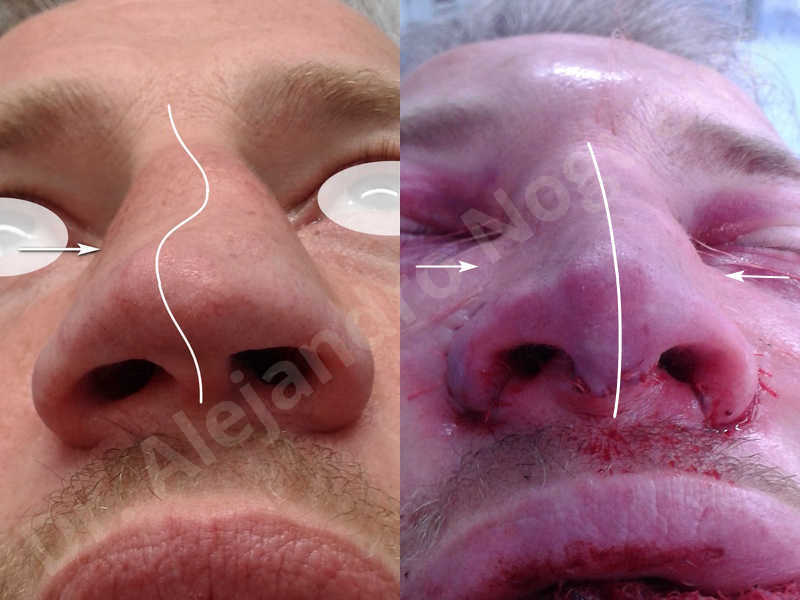 Alar flaring,Alar rim retraction,Asymmetric nose,Asymmetric tip,Bifid columella,Bifid tip,Broad dorsum,Broad nose,Concave lateral cruras,Congenital nose,Crooked nose,Crooked septum,Crooked tip,Dorsum hump,Dorsum ridges,Droopy tip,Failed osteotomies,Flat dorsum,Irregular dorsum,Large alar cartilages,Large nose,Large nostrils,Large sills,Nasal fibrosis,Nasal valve collapse,Overprojected tip,Pinched middle vault,Pinched nose,Plunging tip deformity,Poorly defined tip,Poorly supported tip,Posttraumatic nose,Rhomboid dorsum,Saddle nose deformity,Short septum,Short upper lateral cartilages,Sunken columella,Sunken supratip,Thick skin nose,Tip bossae,Underprojected tip,Alar base resection alarplasty,Columella strut graft,Dorsum hump resection,Dorsum regularization,Extended columella strut graft,Intercrural columella plasty sutures,Interdomal tip plasty sutures,Lateral cruras cephalic resection,Lateral cruras plasty sutures,Lateral cruras repositioning,Lateral cruras shortening resection,Medial cruras shortening resection,Nasal bones osteotomies,Nostril sill resection,Onlay dorsum graft,Onlay supratip graft,Open approach incision,Rib cartilage graft harvesting,Septocolumella graft,Septum caudal extension graft,Septum replacement graft,Spreader graft,Temporalis fascia graft harvesting,Tip defatting,Transdomal tip plasty sutures,Triangular cartilages caudal extension graft - photo 85