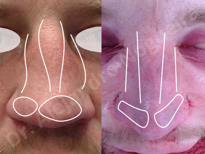 Alar flaring,Alar rim retraction,Asymmetric nose,Asymmetric tip,Bifid columella,Bifid tip,Broad dorsum,Broad nose,Concave lateral cruras,Congenital nose,Crooked nose,Crooked septum,Crooked tip,Dorsum hump,Dorsum ridges,Droopy tip,Failed osteotomies,Flat dorsum,Irregular dorsum,Large alar cartilages,Large nose,Large nostrils,Large sills,Nasal fibrosis,Nasal valve collapse,Overprojected tip,Pinched middle vault,Pinched nose,Plunging tip deformity,Poorly defined tip,Poorly supported tip,Posttraumatic nose,Rhomboid dorsum,Saddle nose deformity,Short septum,Short upper lateral cartilages,Sunken columella,Sunken supratip,Thick skin nose,Tip bossae,Underprojected tip,Alar base resection alarplasty,Columella strut graft,Dorsum hump resection,Dorsum regularization,Extended columella strut graft,Intercrural columella plasty sutures,Interdomal tip plasty sutures,Lateral cruras cephalic resection,Lateral cruras plasty sutures,Lateral cruras repositioning,Lateral cruras shortening resection,Medial cruras shortening resection,Nasal bones osteotomies,Nostril sill resection,Onlay dorsum graft,Onlay supratip graft,Open approach incision,Rib cartilage graft harvesting,Septocolumella graft,Septum caudal extension graft,Septum replacement graft,Spreader graft,Temporalis fascia graft harvesting,Tip defatting,Transdomal tip plasty sutures,Triangular cartilages caudal extension graft - photo 89