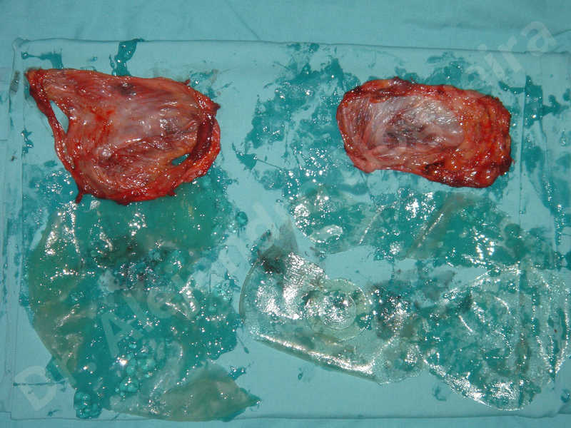 Breast implants capsular contracture,Breast implants capsule calcification,Breast implants displacement malposition,Breast implants riding too high,Broken breast implants,Failed breast lift,Moderately saggy droopy breasts,Waterfall effect breast implants,Capsulectomy - photo 8