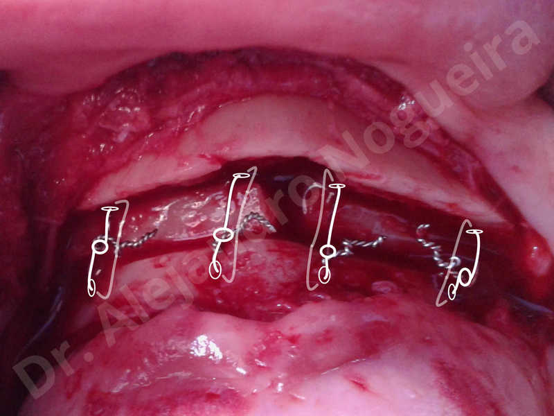 Small chin,Weak chin,Elbow bone graft harvesting,Oblique chin osteotomy,Osseous chin advancement,Two dimensional genioplasty,Vertical osseous chin grafting - photo 11