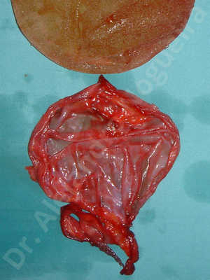 Breast implants capsular contracture,Breast implants capsule calcification,Breast implants displacement malposition,Breast implants riding too high,Breast implants rippling,Lateral breasts,Slightly saggy droopy breasts,Too far apart wide cleavage breast implants,Too far apart wide cleavage breasts,Too narrow breast implants,Wide breasts,Capsulectomy