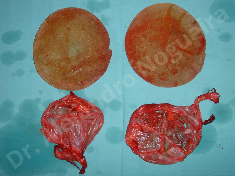 Breast implants capsular contracture,Breast implants capsule calcification,Breast implants displacement malposition,Breast implants riding too high,Breast implants rippling,Lateral breasts,Slightly saggy droopy breasts,Too far apart wide cleavage breast implants,Too far apart wide cleavage breasts,Too narrow breast implants,Wide breasts,Capsulectomy - photo 2