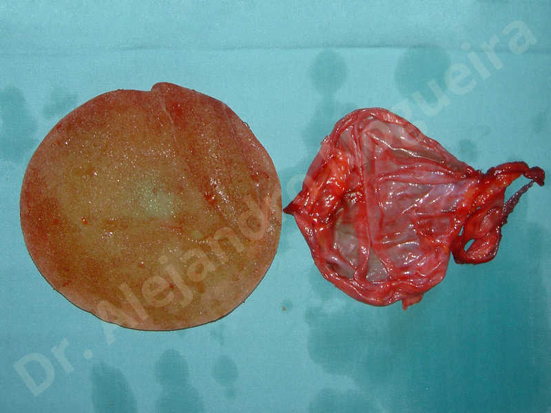 Breast implants capsular contracture,Breast implants capsule calcification,Breast implants displacement malposition,Breast implants riding too high,Breast implants rippling,Lateral breasts,Slightly saggy droopy breasts,Too far apart wide cleavage breast implants,Too far apart wide cleavage breasts,Too narrow breast implants,Wide breasts,Capsulectomy - photo 6
