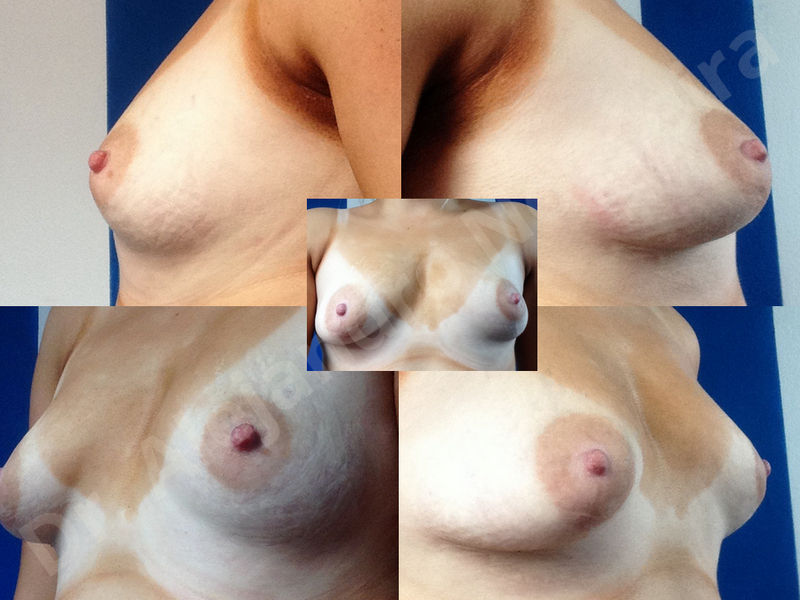 Asymmetric breasts,Breast implants animation muscle flex deformity,Breast implants capsular contracture,Breast implants displacement malposition,Breast implants double bubble deformity,Breast implants excessive movement,Breast implants riding too high,Breast implants side boob,Breast implants visibility palpability,Cross eyed breasts,Cross eyed breasts implants,Empty breasts,Extremely large breasts,Extremely saggy droopy breasts,Large areolas,Lateral breasts,Mildly large breasts,Mildly saggy droopy breasts,Moderately large breasts,Moderately saggy droopy breasts,Narrow breasts,Pendulous breasts,Pigeon chest,Severely large breasts,Severely saggy droopy breasts,Skinny breasts,Slightly large breasts,Slightly saggy droopy breasts,Small breasts,Sunken chest,Too far apart wide cleavage breast implants,Too far apart wide cleavage breasts,Too narrow breast implants,Too wide breast implants,Tuberous breasts,Waterfall effect breast implants,Wide breasts,Anatomical shape,Anchor incision,Areola reduction,Capsulectomy,Circumareolar incision,Dual plane pocket,Inframammary incision,Internal bra capsulorrhaphy,Lower hemi periareolar incision,Round shape,Subfascial pocket plane,Tuberous mammoplasty - photo 129