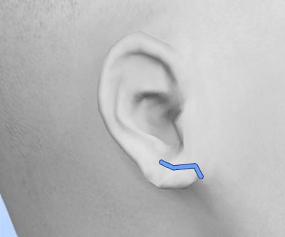 scars earlobe reduction