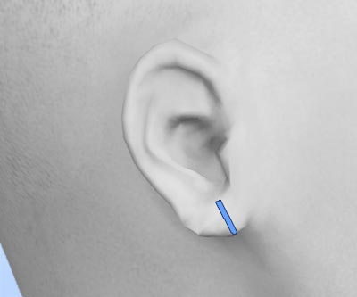 scars earlobe repair