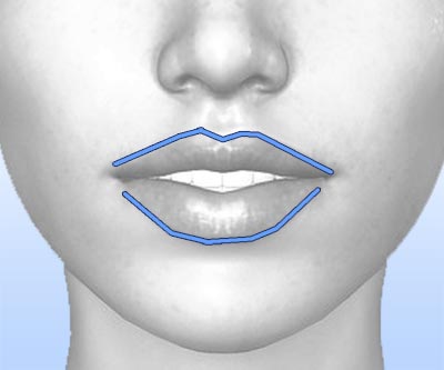 scars lip lift - II
