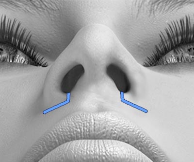 scars reconstruction rhinoplasty - I