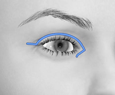 scars upper asian blepharoplasty - I